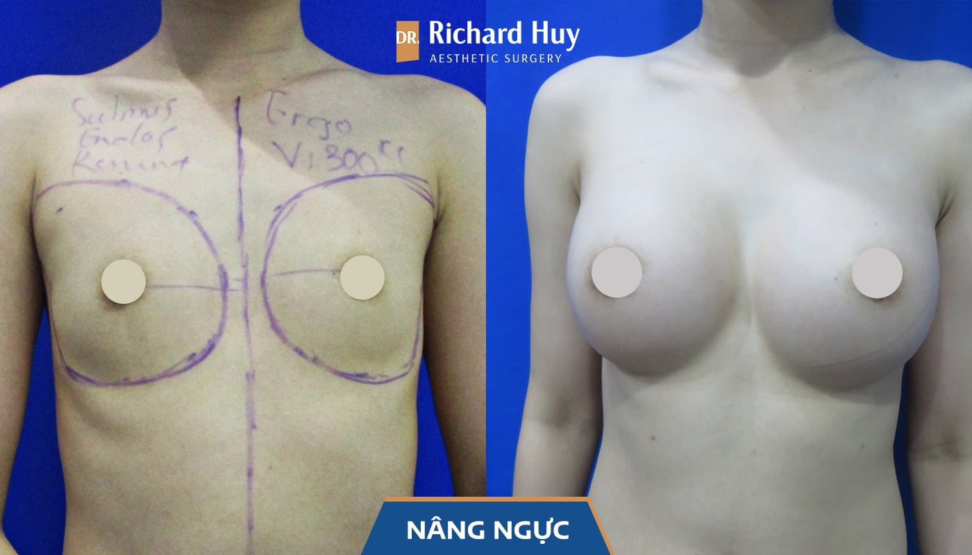 ALBUM ẢNH nâng ngực