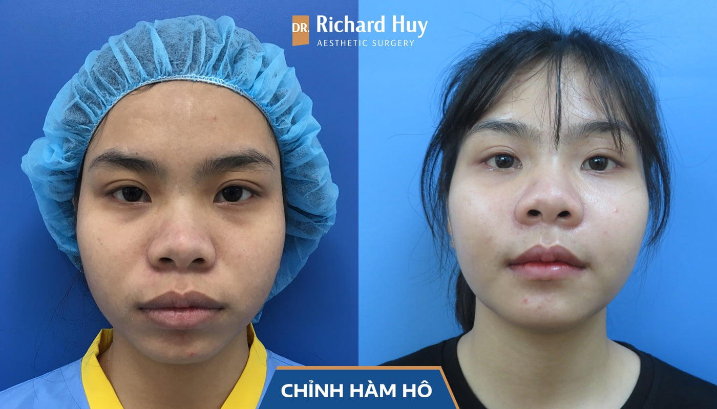 Khách hàng thực hiện chỉnh hàm hô