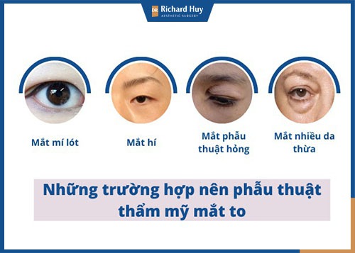 Trường hợp nên phẫu thuật thẩm mỹ mắt to hơn 