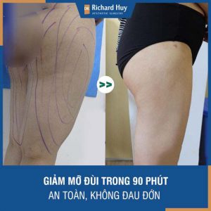 Giảm mỡ đùi chỉ trong vòng 60 phút - Thon gọn, an toàn, không đau đớn