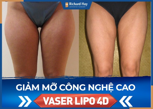 Hút mỡ đùi công nghệ Vaser Lipo 4.0