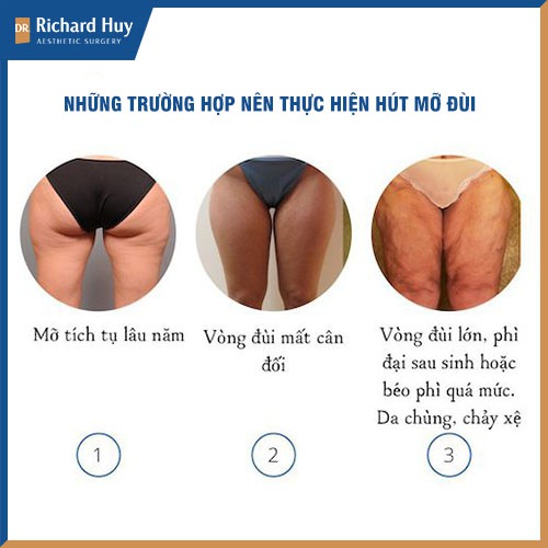 Những trường hợp nên thực hiện hút mỡ đùi