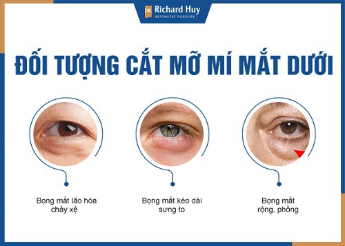 Đối tượng cắt mỡ mí mắt dưới 