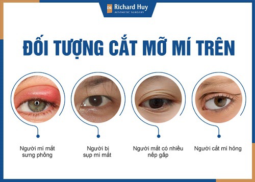 Đối tượng cắt mỡ mí trên 