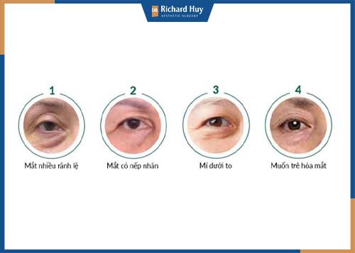 Đối tượng xóa rãnh rãnh lệ 