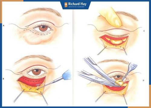 Mô phỏng kĩ thuật xóa rãnh lệ bằng cách dịch chuyển mỡ 