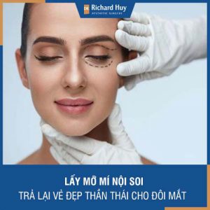 Lấy mỡ mí nội soi - Trả lại vẻ đẹp thần thái cho đôi mắt