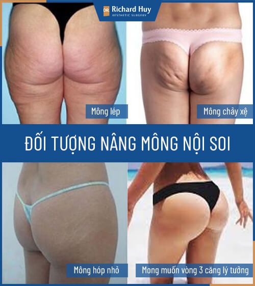 Đối tượng nâng mông túi độn 