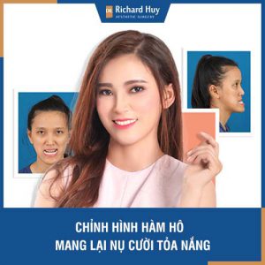 Chỉnh hình hàm hô - Mang lại nụ cười tỏa nắng