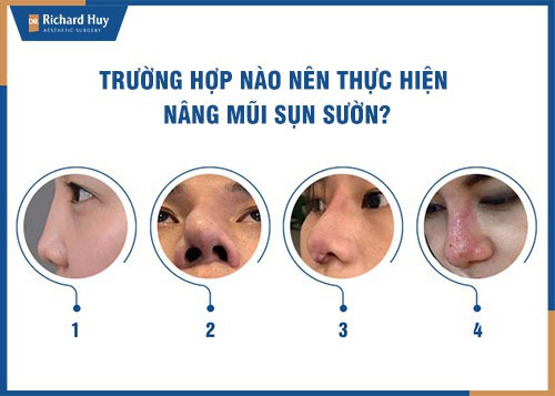 Những khuyết điểm vùng mũi nên thực hiện nâng mũi sụn sườn 