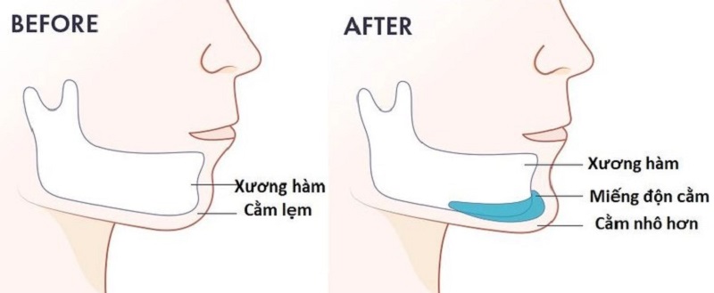 Phương pháp độn cằm sử dụng chất liệu độn để giúp cằm nhô hơn