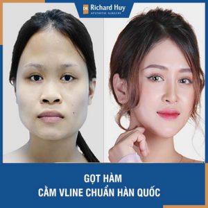 Gọt hàm - Giúp bạn sở hữu hàm Vline chuẩn Hàn Quốc