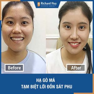 Hạ gò má - Tạm biệt lời đồn sát phu