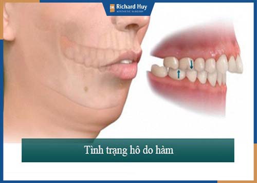 Cấu trúc xương hàm phát triển quá mức 