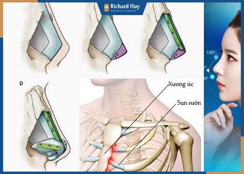 Sử dụng xương sụn sườn để tạo phần sống mũi cao và tự nhiên 