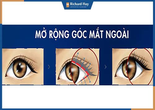 Mô phỏng kỹ thuật mở rộng góc mắt ngoài 