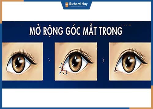 Mô phỏng kỹ thuật mở rộng góc mắt trong 