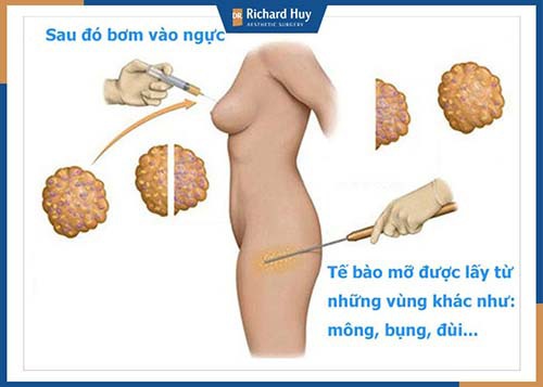 Kỹ thuật nâng ngực bằng mỡ tự thân 