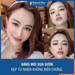 Nâng mũi sụn sườn - Đẹp tự nhiên không biến chứng