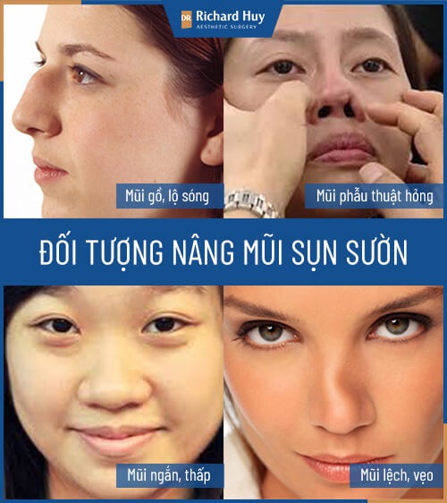 Đối tượng nâng mũi sụn sườn