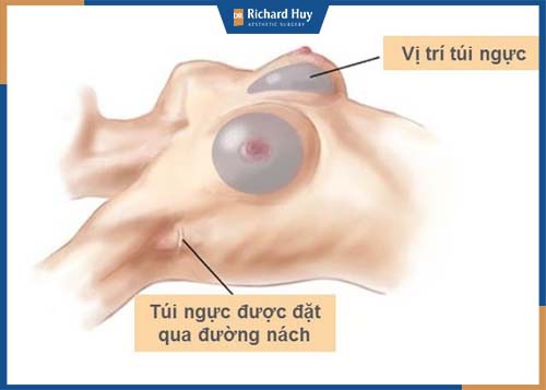 Nâng ngực qua đường nách dễ dàng vị trí khó phát hiện ra phẫu thuật 