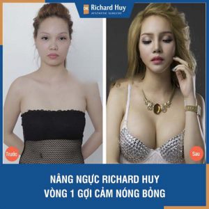 Nâng ngực Dr Richard Huy - Vòng 1 gợi cảm, nóng bỏng