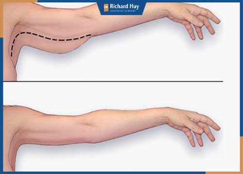 Hình ảnh khách hàng trước và sau khi hút mỡ cánh tay