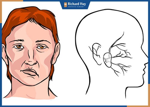 Có nên thực hiện căng da mặt hay không?