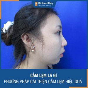 Cằm lẹm là gì - Phương pháp cải thiện cằm lẹm hiệu quả