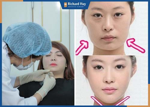 Tiêm Filler thay đổi cằm ngắn nhanh chóng, nhận thấy sự thay đổi rõ rệt 