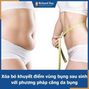 Căng da bụng - Giải pháp an toàn, hiệu quả cho phụ nữ sau khi sinh