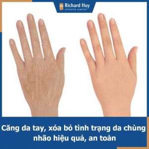 Căng da tay trong vòng 1 nốt nhạc tại Dr.Richard Huy với hiệu quả bền lâu