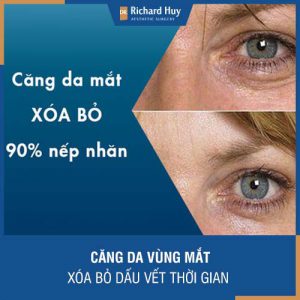 Căng da vùng mắt - Xóa bỏ dấu vết thời gian