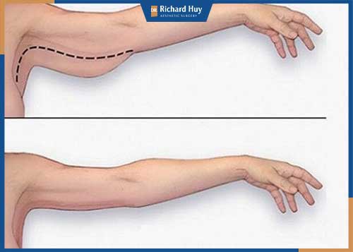 Cánh tay thon gọn hơn hẳn sau khi tiến hành phẫu thuật căng da