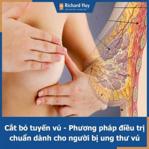 Phẫu thuật cắt tuyến vú là gì? Hiệu quả mang lại sau khi cắt tuyến vú và cách chăm sóc sau phẫu thuật