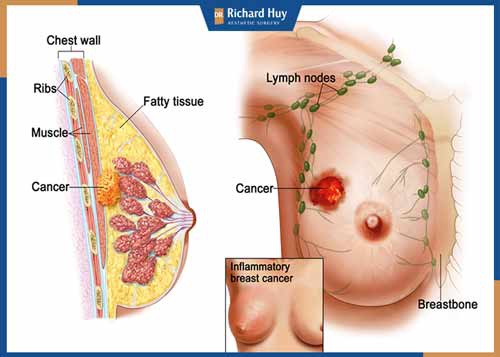 Cắt tuyến vú là phương pháp được sử dụng dành cho người bị ung thư vú