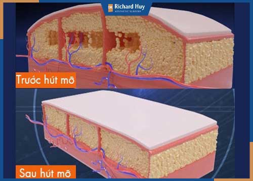 Mô mỡ nhanh chóng sau khi được hút bằng công nghệ Vaser Lipo