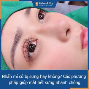 Nhấn mí bao lâu hết sưng? Các biện pháp giúp hạn chế tình trạng sưng mí hiệu quả