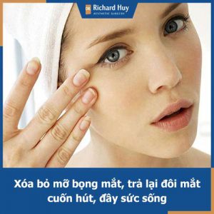 Lấy mỡ bọng mắt - Sở hữu đôi mắt to tròn, trẻ trung và cân đối chỉ với 45 phút