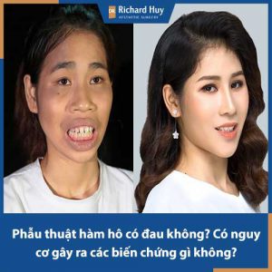 Phẫu thuật hàm hô có đau không? Có nguy cơ xảy ra biến chứng hay không?