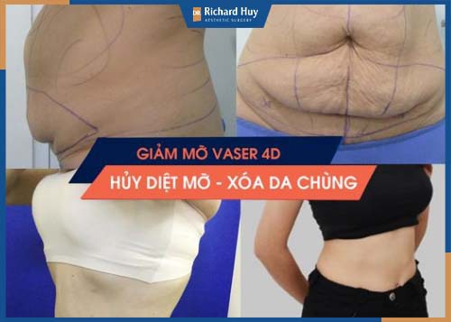 Công nghệ Vaser Lipo 4D hủy diệt mỡ, xóa da chùng