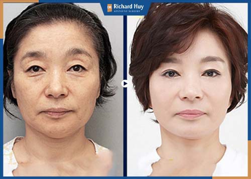 Sau phẫu thuật, cấu trúc bề mặt da được thay đổi và tăng cường sản sinh ra lượng collagen cần thiết cho làn da. 