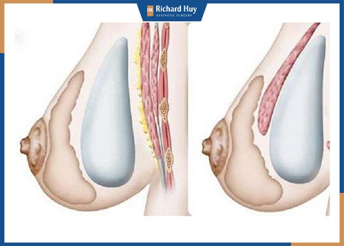 Đặt túi độn hình giọt nước có ổn không?