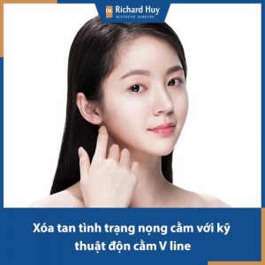 Hai cằm có xấu hay không? Làm thế nào để loại bỏ tình trạng hai cằm hiệu quả?