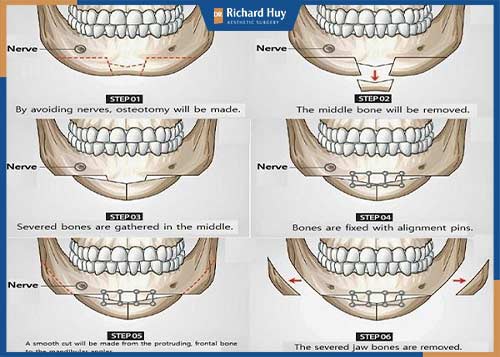 Độn cằm V line ở đâu tốt?