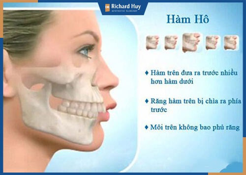 Phẫu thuật hàm hô giá rẻ