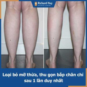 Hút mỡ bắp chân - Bí quyết giảm mỡ bắp chân nhanh chóng mà không cần luyện tập