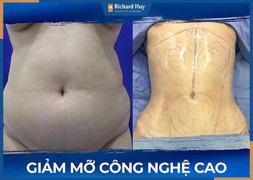 Hút mỡ bụng công nghệ cao cùng Dr. Richard Huy không gây đau đớn 