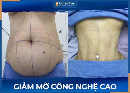 Hút mỡ công nghệ cao giảm mỡ trong 90 phút 