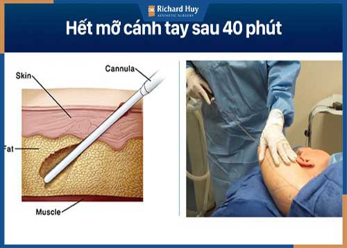 Mỡ thừa giảm ngay sau khi hút